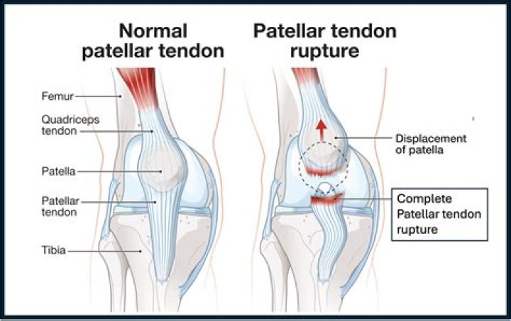 Can patellar tendonitis cause shin pain?