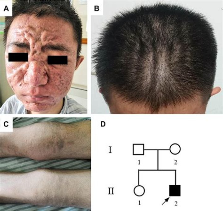 Does cutis verticis gyrata get worse?