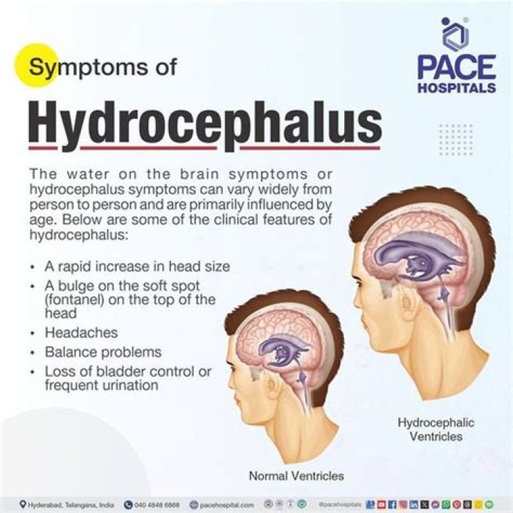 How hydrocephalus affects quality of life?