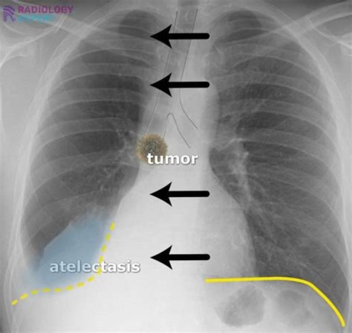 In atelectasis the calyces are?