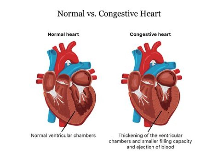 Is congestive heart failure curable?