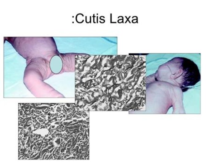 What is cutis laxa type 3?